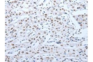 The image on the left is immunohistochemistry of paraffin-embedded Human lung cancer tissue using ABIN7189621(ACIN1 Antibody) at dilution 1/30, on the right is treated with synthetic peptide. (ACIN1 anticorps)