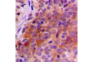 Immunohistochemical analysis of TXNRD2 staining in human breast cancer formalin fixed paraffin embedded tissue section.