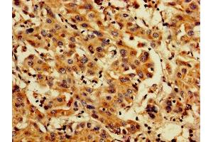 IHC image of ABIN7164696 diluted at 1:200 and staining in paraffin-embedded human liver cancer performed on a Leica BondTM system. (PDCD6 anticorps  (AA 1-191))