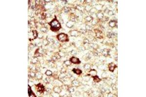 Formalin-fixed and paraffin-embedded human cancer tissue reacted with the primary antibody, which was peroxidase-conjugated to the secondary antibody, followed by AEC staining.