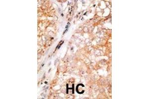 Formalin-fixed and paraffin-embedded human cancer tissue reacted with the primary antibody, which was peroxidase-conjugated to the secondary antibody, followed by DAB staining.