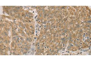 Immunohistochemistry of paraffin-embedded Human ovarian cancer using DMRT3 Polyclonal Antibody at dilution of 1:50 (DMRT3 anticorps)