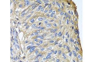 Immunohistochemistry of paraffin-embedded Human prostate cancer using APOA1 Polyclonal Antibody at dilution of 1:100 (40x lens). (APOA1 anticorps)