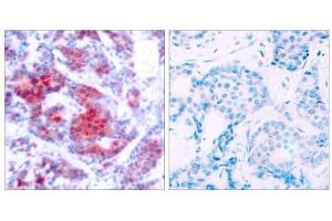 Immunohistochemical analysis of paraffin-embedded human breast carcinoma tissue using STAT4 (phospho-Tyr693) antibody (E011047). (STAT4 anticorps  (pTyr693))