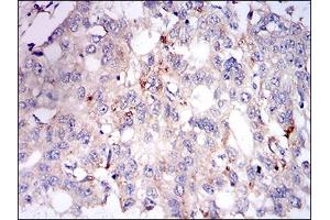 Immunohistochemical analysis of paraffin-embedded esophageal cancer tissues using PLIN2 mouse mAb with DAB staining. (ADRP anticorps  (AA 286-437))