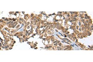 Immunohistochemistry of paraffin-embedded Human ovarian cancer tissue using SPRTN Polyclonal Antibody at dilution of 1:65(x200) (Spartan anticorps)