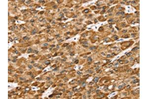 The image on the left is immunohistochemistry of paraffin-embedded Human liver cancer tissue using ABIN7192683(STK32B Antibody) at dilution 1/25, on the right is treated with synthetic peptide. (STK32B anticorps)