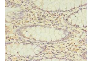 Immunohistochemistry of paraffin-embedded human colon cancer using ABIN7162969 at dilution of 1:100