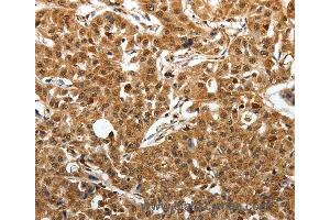 Immunohistochemistry of Human lung cancer using SOX13 Polyclonal Antibody at dilution of 1:50 (SOX13 anticorps)