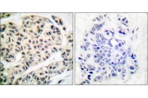 Immunohistochemistry analysis of paraffin-embedded human breast carcinoma, using MEF2A (Phospho-Thr319) Antibody.