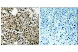 Immunohistochemical analysis of paraffin-embedded human breast carcinoma tissue using G3BP-1 (Ab-232) antibody (E021102). (G3BP1 anticorps)