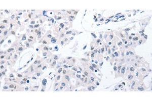 Immunohistochemistry of paraffin-embedded Human lung cancer using POMC Polyclonal Antibody at dilution of 1:30 (POMC anticorps)