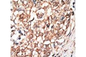 IHC analysis of FFPE human hepatocarcinoma tissue stained with the BMPR1B antibody (BMPR1B anticorps  (AA 472-502))