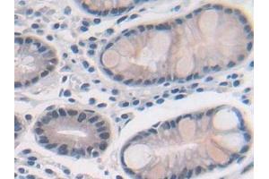Detection of MAT2a in Human Stomach cancer Tissue using Polyclonal Antibody to Methionine Adenosyltransferase II Alpha (MAT2a)