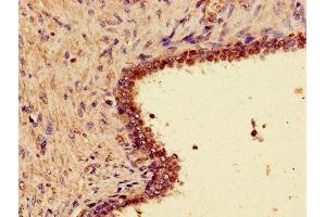 Immunohistochemistry of paraffin-embedded human prostate cancer using ABIN7166309 at dilution of 1:100 (WNT7A anticorps  (AA 126-302))