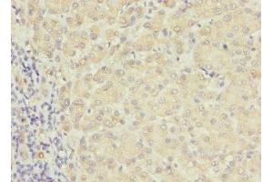 Immunohistochemistry of paraffin-embedded human liver cancer using ABIN7167233 at dilution of 1:100