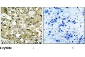Immunohistochemical analysis of paraffin-embedded human breast carcinoma tissue using KDR polyclonal antibody  . (VEGFR2/CD309 anticorps)