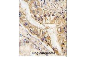 Paraformaldehyde-fixed, paraffin embedded human lung carcinoma tissue, Antigen retrieval by boiling in sodium citrate buffer (pH6. (EPH Receptor B2 anticorps)