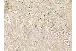 ABIN6258768 and ABIN6275107 at 1/100 staining human hepatocellular carcinoma by IHC-P. (ELOVL5 anticorps  (C-Term))