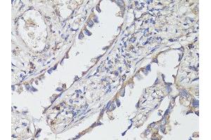 Immunohistochemistry of paraffin-embedded human lung cancer using NTRK2 antibody (ABIN5998390) at dilution of 1/200 (40x lens). (TRKB anticorps)