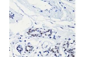 Immunohistochemistry of paraffin-embedded Human breast using Acetyl-Histone H2A-K5 Polyclonal Antibody at dilution of 1:100 (40x lens). (Histone H2A anticorps  (acLys5))