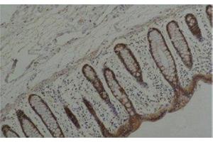 Immunohistochemistry of paraffin-embedded Human colon carcinoma tissue using HSP90 alpha Monoclonal Antibody at dilution of 1:200. (HSP90AA2 anticorps)