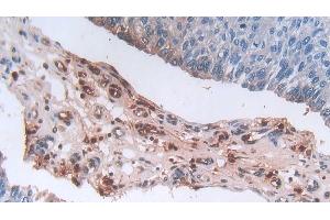 Detection of DEFa3 in Human Prostate cancer Tissue using Polyclonal Antibody to Defensin Alpha 3, Neutrophil Specific (DEFa3) (DEFa3 anticorps  (AA 21-94))