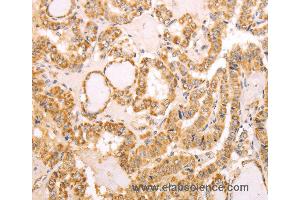 Immunohistochemistry of Human thyroid cancer using NAMPT Polyclonal Antibody at dilution of 1:30 (NAMPT anticorps)