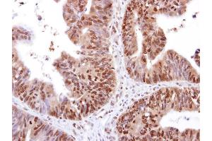 IHC-P Image RED antibody [N1], N-term detects RED protein at cytosol and nucleus on human colon carcinoma by immunohistochemical analysis.