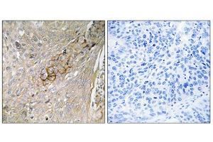 Immunohistochemistry analysis of paraffin-embedded human lung carcinoma tissue, using SC6A6 antibody. (TAUT anticorps  (C-Term))