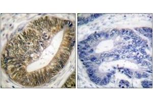 Immunohistochemistry analysis of paraffin-embedded human colon carcinoma, using SEPARASE (Phospho-Ser801) Antibody. (Separase anticorps  (pSer801))