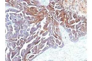 Formalin-fixed, paraffin-embedded human ovarian carcinoma stained with TAG-72 antibody (B72. (TAG-72 anticorps)