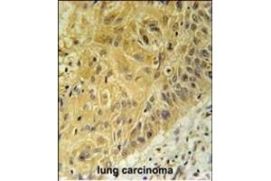 WNT5A Antibody (Center) (ABIN651869 and ABIN2840430) immunohistochemistry analysis in formalin fixed and paraffin embedded human lung carcinoma followed by peroxidase conjugation of the secondary antibody and DAB staining. (WNT5A anticorps  (AA 185-213))