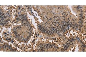 Immunohistochemistry of paraffin-embedded Human colon cancer tissue using JAG2 Polyclonal Antibody at dilution 1:30 (JAG2 anticorps)
