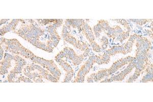 Immunohistochemistry of paraffin-embedded Human thyroid cancer tissue using ACSF2 Polyclonal Antibody at dilution of 1:30(x200) (ACSF2 anticorps)