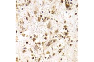 Immunohistochemistry of paraffin-embedded human liver cancer using PRPF3 Antibody. (PRPF3 anticorps  (AA 1-280))