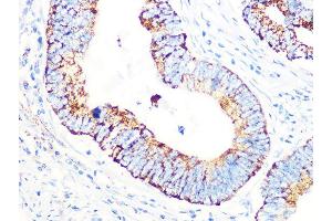 Immunohistochemistry of paraffin-embedded human colon carcinoma using PDHB Rabbit mAb (ABIN7269772) at dilution of 1:100 (40x lens). (PDHB anticorps)