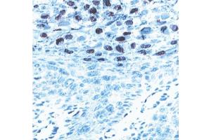 Immunohistochemical staining for human papilloma virus (HPV) type 16, L1 protein.