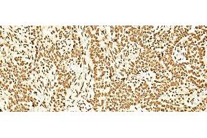 Immunohistochemistry of paraffin-embedded Human ovarian cancer tissue using ILF3 Polyclonal Antibody at dilution of 1:60(x200) (Interleukin enhancer-binding factor 3 (ILF3) anticorps)