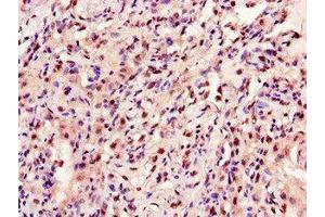 Immunohistochemistry of paraffin-embedded human lung cancer using ABIN7144222 at dilution of 1:100 (ANKRD23 anticorps  (AA 1-200))