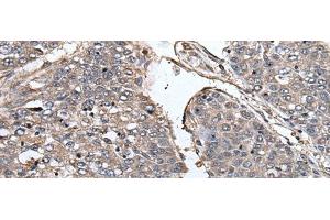 Immunohistochemistry of paraffin-embedded Human liver cancer tissue using PRUNE Polyclonal Antibody at dilution of 1:40(x200) (PRUNE anticorps)