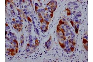 IHC image of ABIN7127454 diluted at 1:100 and staining in paraffin-embedded human liver cancer performed on a Leica BondTM system.