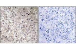 Immunohistochemistry analysis of paraffin-embedded human liver carcinoma tissue, using GIPR Antibody. (GIPR anticorps  (AA 93-142))