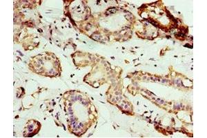 Immunohistochemistry of paraffin-embedded human breast cancer using ABIN7144352 at dilution of 1:100