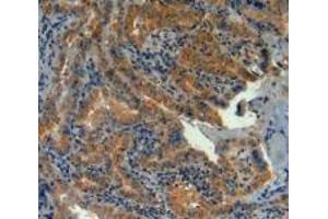 IHC-P analysis of Human Thyroid Cancer Tissue, with DAB staining. (LPCAT3 anticorps  (AA 122-233))