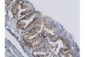 Formalin-fixed and paraffin embedded bladder cancer labeled with Anti-MCM-2 Polyclonal Antibody, Unconjugated  at 1:200 followed by conjugation to the secondary antibody and DAB staining