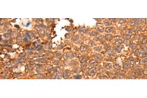 Immunohistochemistry of paraffin-embedded Human ovarian cancer tissue using HOXD8 Polyclonal Antibody at dilution of 1:40(x200) (HOXD8 anticorps)