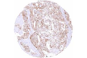 Clear cell ovarian carcinoma with moderate occludin staining of tumor cells
