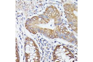 Immunohistochemistry of paraffin-embedded human colon carcinoma using TRIP4 antibody (ABIN7270824) at dilution of 1:100 (40x lens).