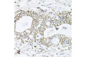 Immunohistochemistry of paraffin-embedded human gastric cancer using B1 antibody (ABIN6127389, ABIN6137306, ABIN6137309 and ABIN6221475) at dilution of 1:100 (40x lens). (ATP1B1 anticorps  (AA 63-303))
